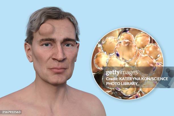 lipoma on man's forehead, illustration - lipoma stock illustrations