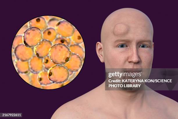 lipoma on man's forehead, illustration - lipoma stock illustrations