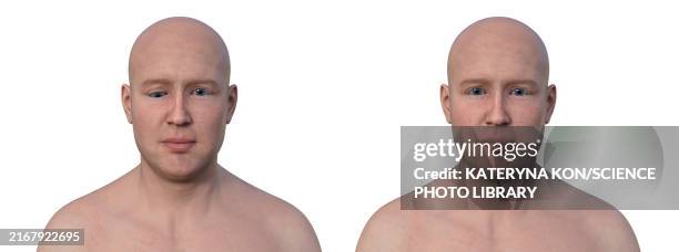 man with hypotropia, illustration - strabismus stock illustrations