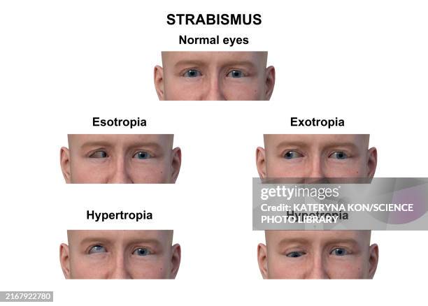 Refractive Strabismus 78 Strabismus Treatment High Res Illustrations - Getty Images
