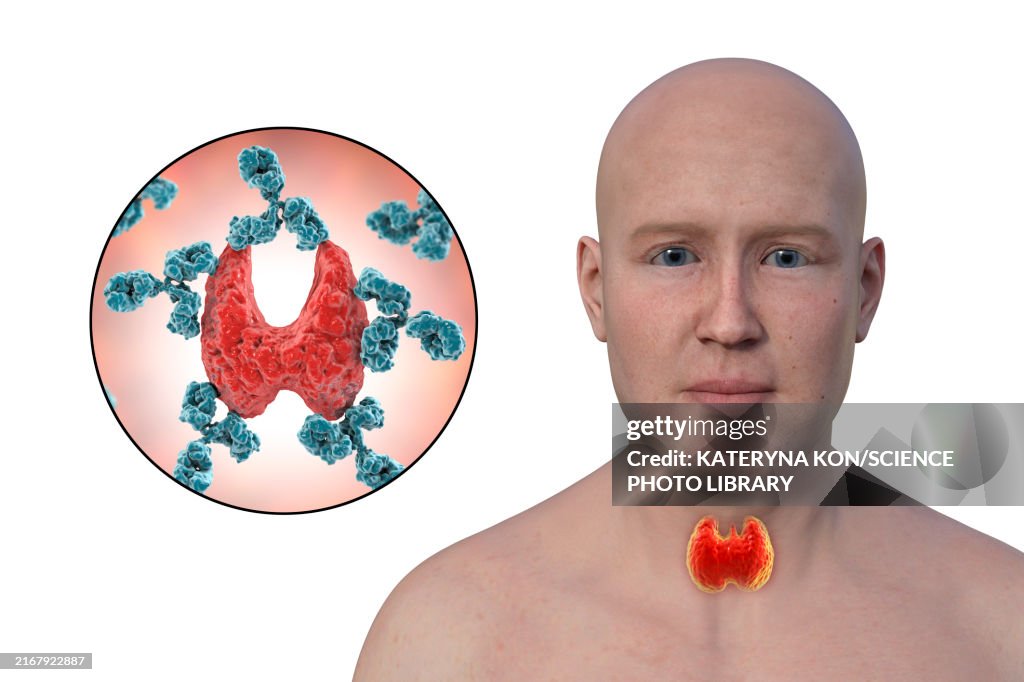 Hashimoto's thyroiditis, conceptual illustration
