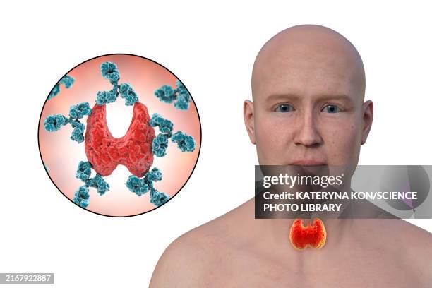 hashimoto's thyroiditis, conceptual illustration - hashimotos thyroiditis stock illustrations