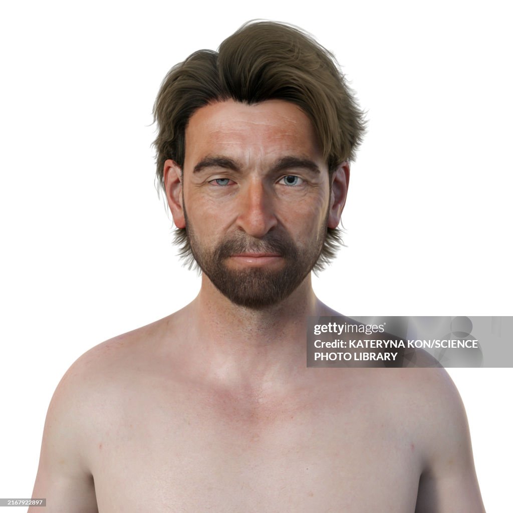 Man with Horner syndrome, illustration
