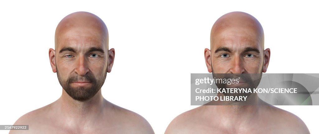 Man with Horner syndrome, illustration
