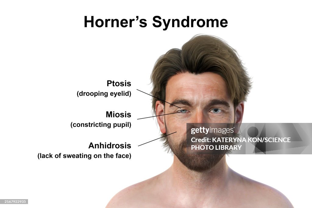 Man with Horner syndrome, illustration