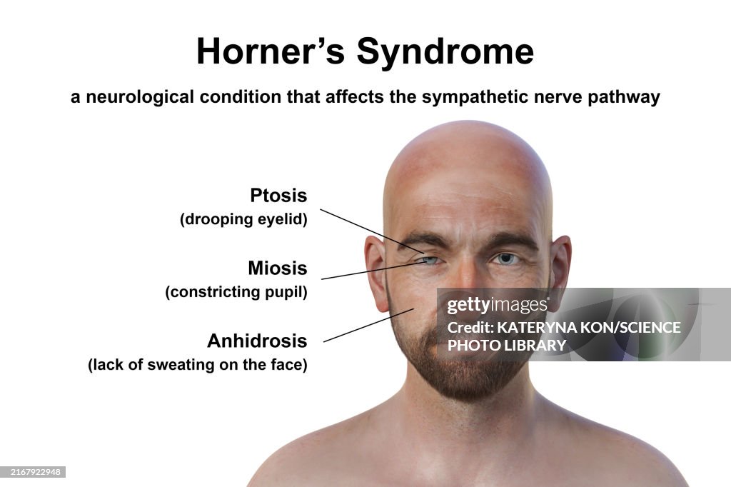 Man with Horner syndrome, illustration