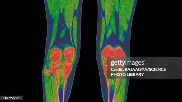 Tibia Scan 2,524 Tibia Anatomy Stock Photos, High-Res Pictures, and Images - Getty ...