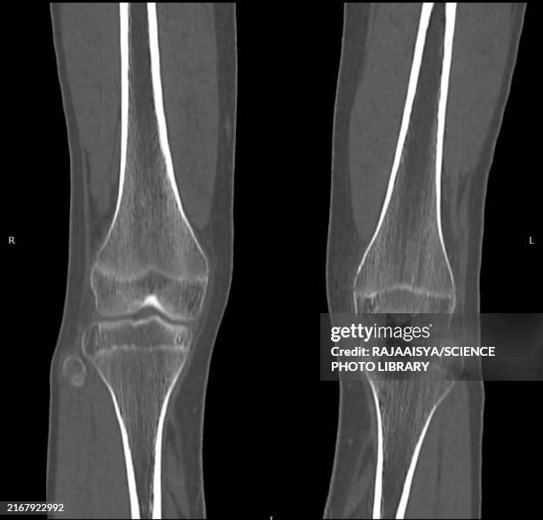 Tibia Scan 2,524 Tibia Anatomy Stock Photos, High-Res Pictures, and Images - Getty ...