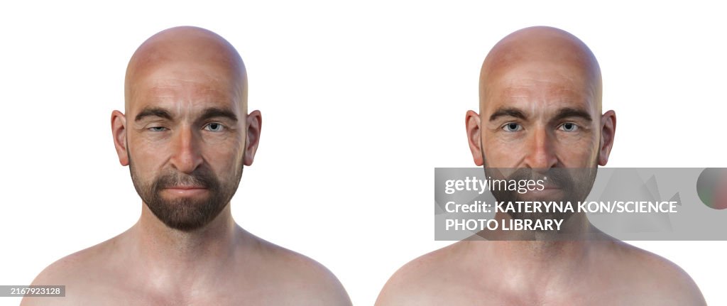 Man with ptosis, illustration