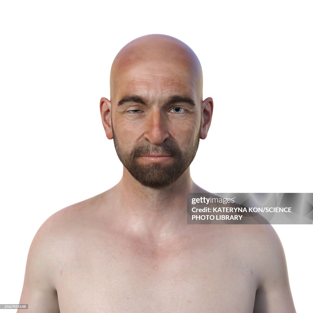 Man with ptosis, illustration