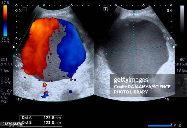 abdominal aortic aneurism, ultrasound scan - aorta imagens e fotografias de stock