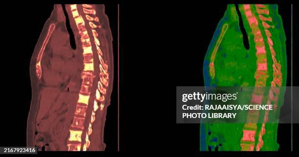 bone cancer, ct scan - human body trunk stock pictures, royalty-free photos & images