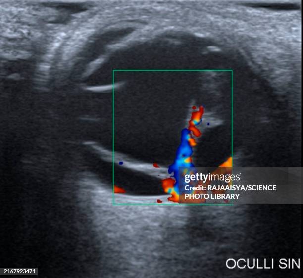 detached retina, ultrasound scan - internal organ stock pictures, royalty-free photos & images
