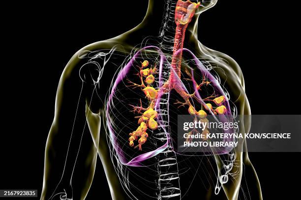 stockillustraties, clipart, cartoons en iconen met lungs affected by cystic fibrosis, illustration - slijm