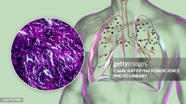 lungs affected by silicosis, illustration - lung cancer stock illustrations