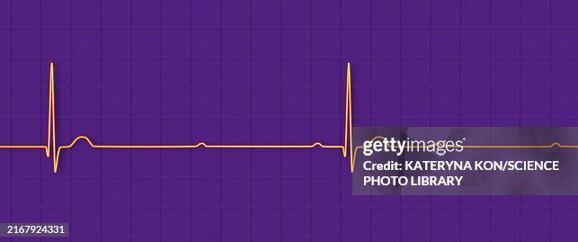 Complete Heart Block Electrocardiogram Illustration High-Res Vector ...