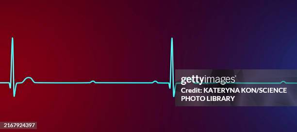 complete heart block electrocardiogram, illustration - av stock illustrations