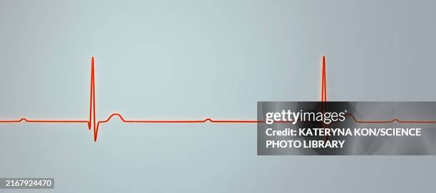 complete heart block electrocardiogram, illustration - av stock illustrations
