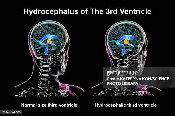 enlargement of the third brain ventricle, illustration - distorted body stock illustrations