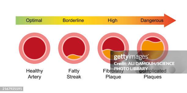 atherosclerosis stages, illustration - coronary arteries diagram stockfoto's en -beelden