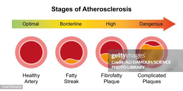 atherosclerosis stages, illustration - coronary arteries diagram stockfoto's en -beelden