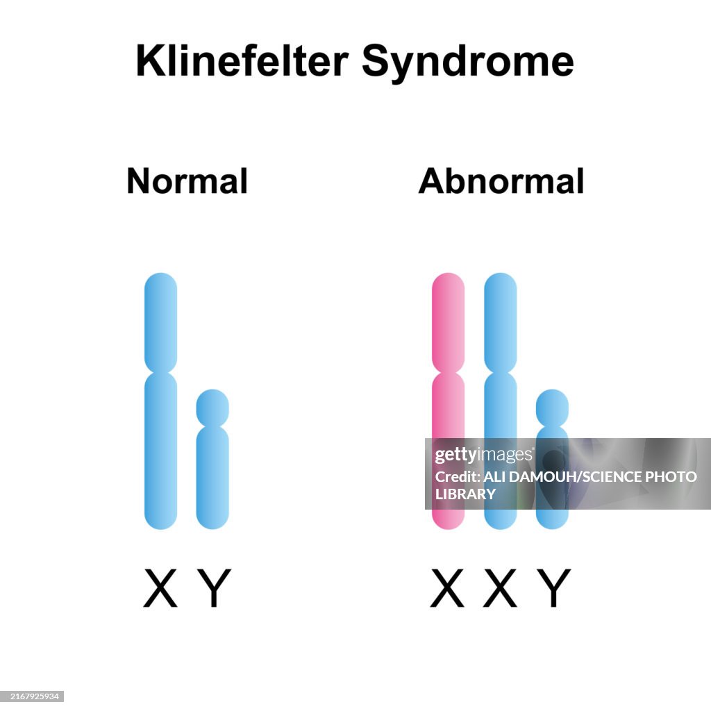 Klinefelter Syndrome Illustration High Res Vector Graphic Getty Images klinefelter-syndrome-illustration-high-res-vector-graphic-getty-images