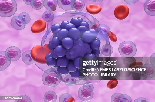 Diffuse large B-cell lymphoma, illustration Diffuse large B-cell lymphoma, illustration