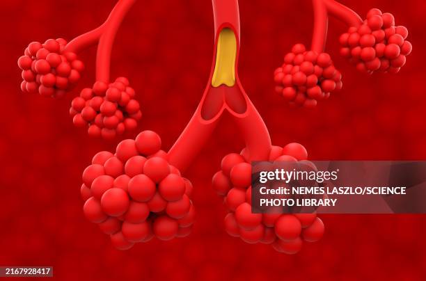 cystic fibrosis, illustration - mukoviszidose stock-grafiken, -clipart, -cartoons und -symbole