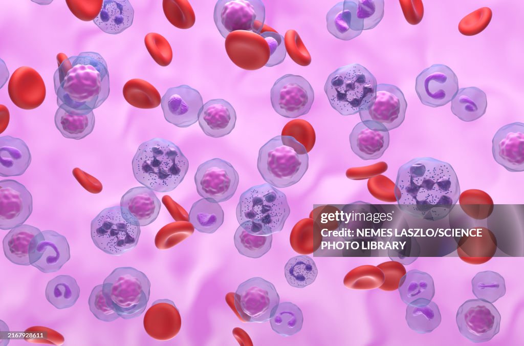 Hypersegmented Neutrophils In Whim Syndrome Illustration High-Res ...