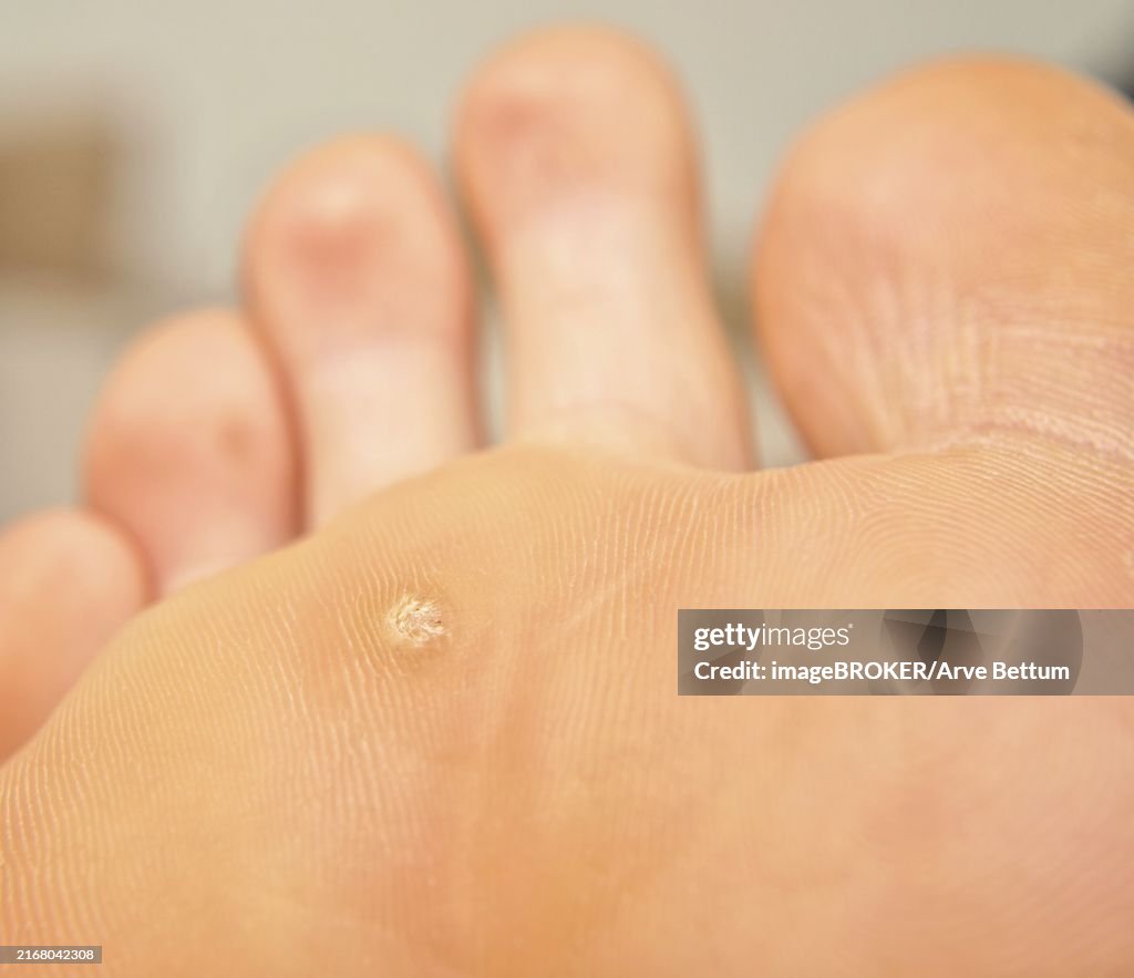 Callus And Hyperkeratosis On Feet Closeup Dried Skin High-Res Stock ...