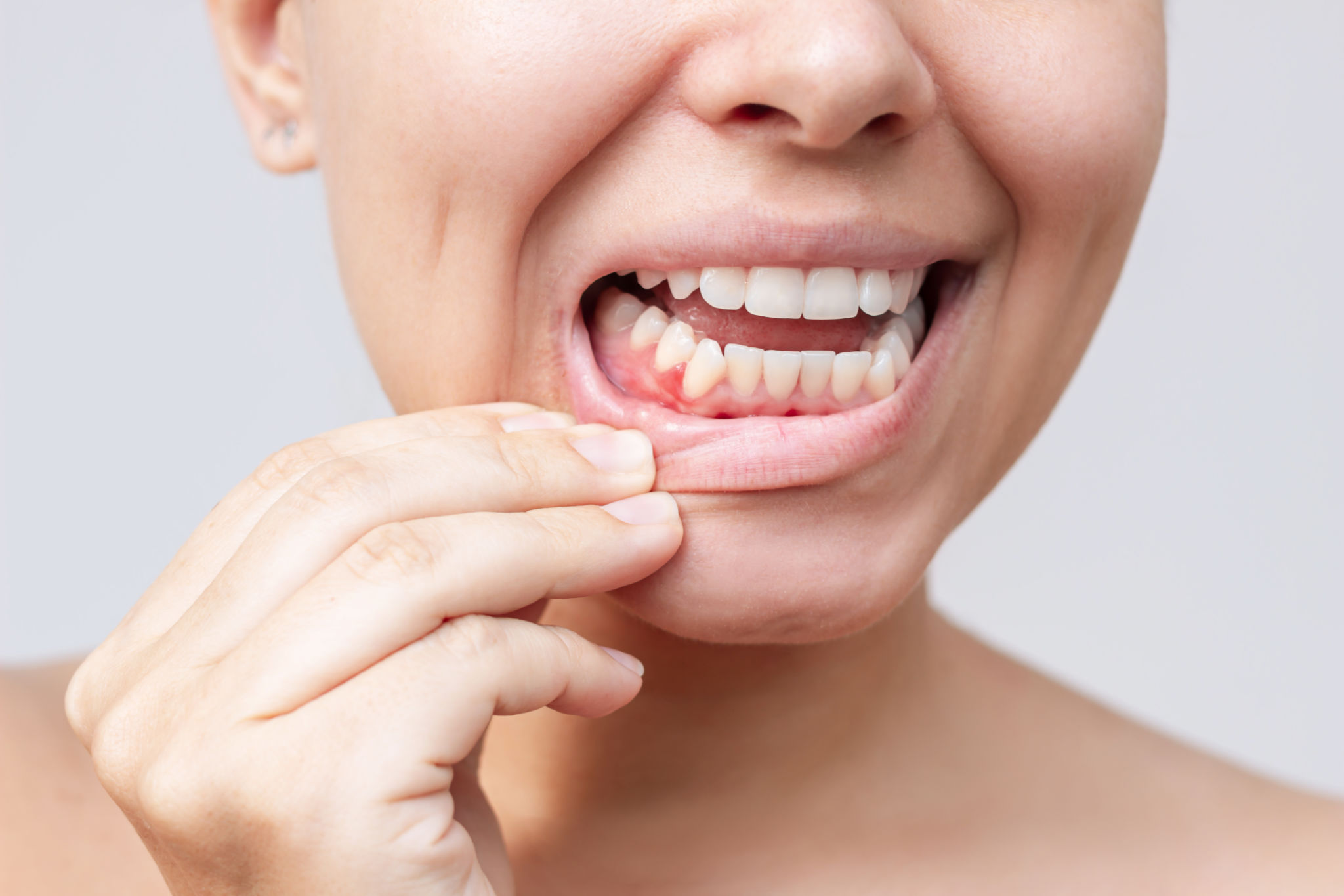 bleeding gums