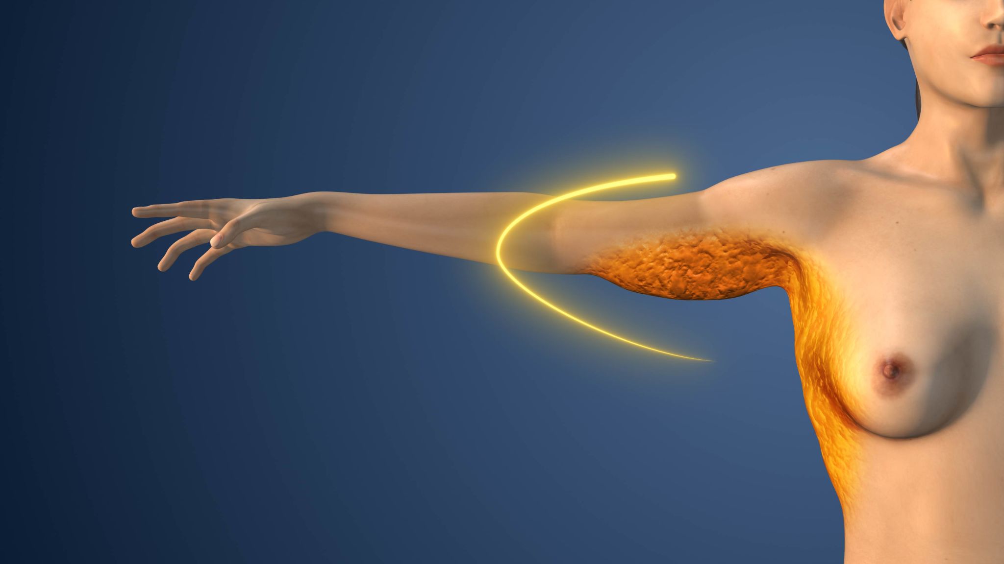 endosleeve procedure