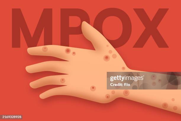 23 Smallpox Rash Stock Photos, High-Res Pictures, and Images - Getty Images