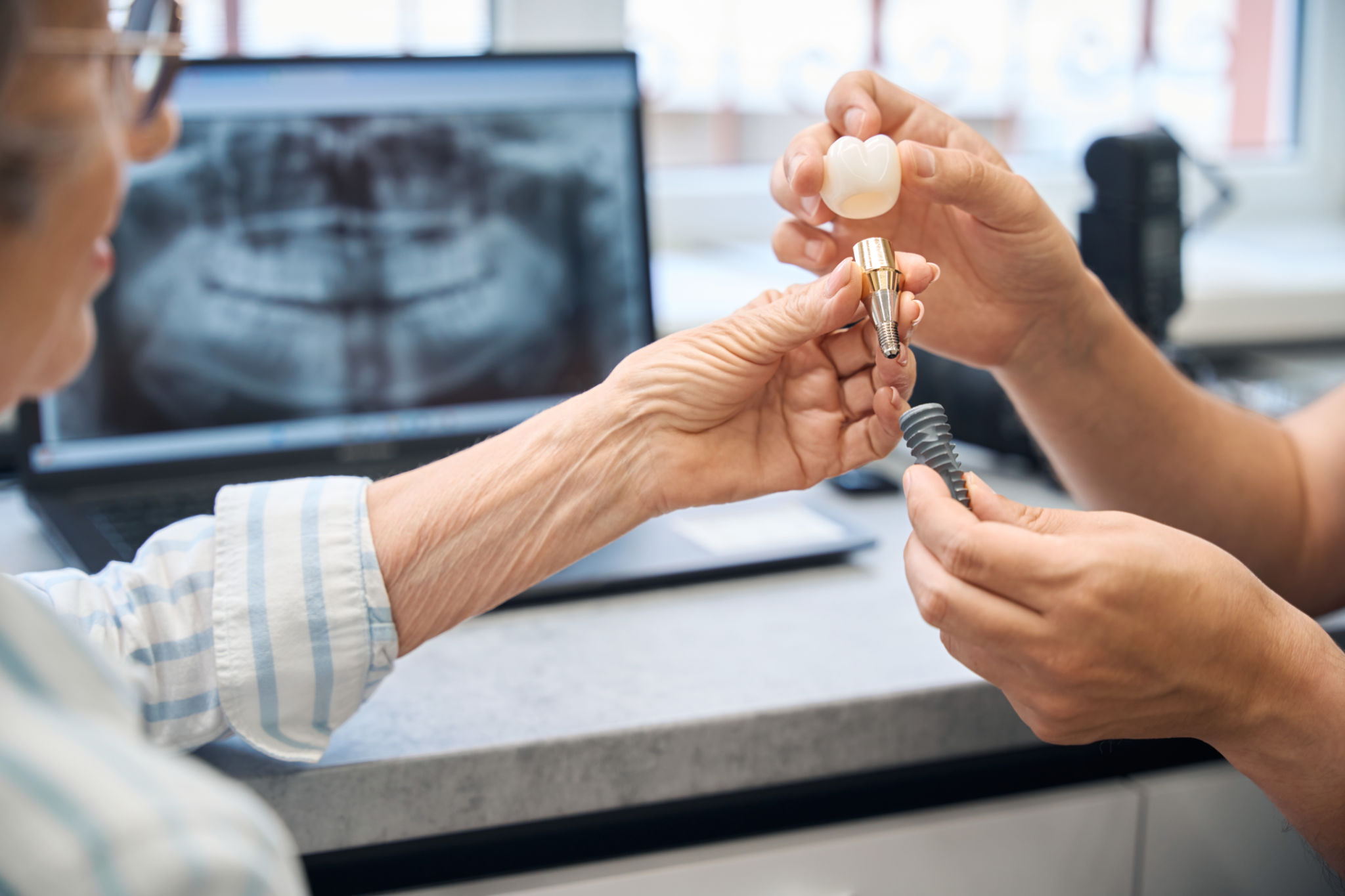 dental implants