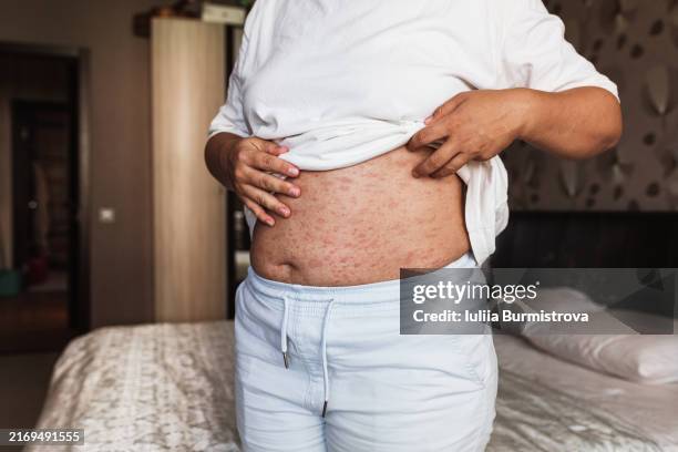Overweight Rash 243 Mature Woman Rash Stock Photos, High-Res Pictures, and Images ...