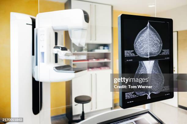 detailed mammogram images displayed for breast cancer analysis. mammography scanner in background. - bröstcancer bildbanksfoton och bilder