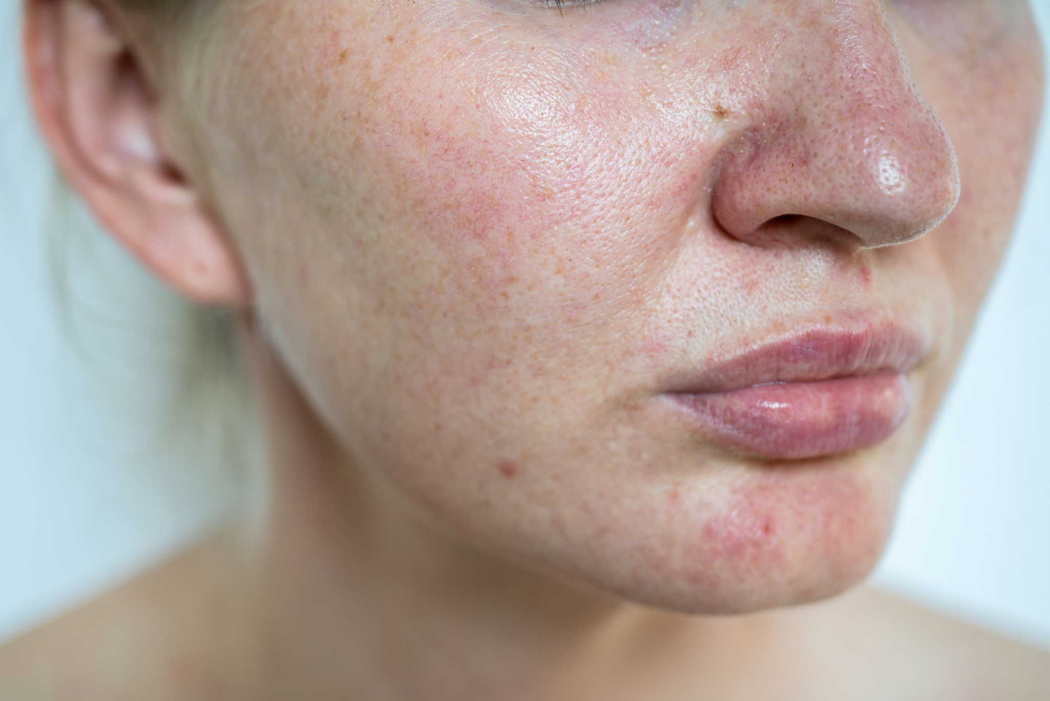 skin tone analysis