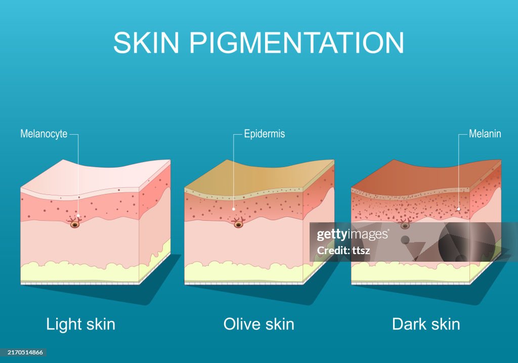 Skin Pigmentation Human Skin Color Ranges High-Res Vector Graphic ...