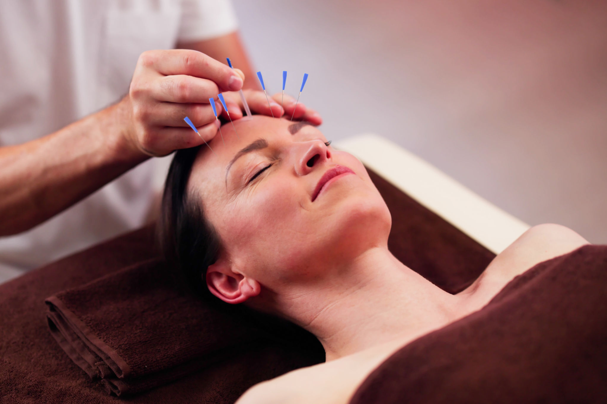 acupuncture therapy