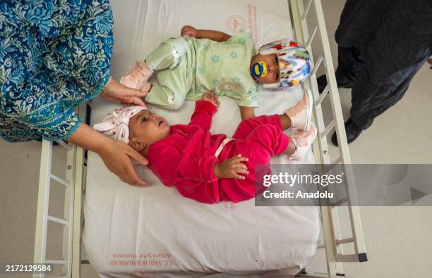 Mirha and Minal, 8-month-old Pakistani twins born conjoined at the head, are seen during their healing process after surgery at Bilkent City Hospital...