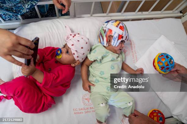 Mirha and Minal, 8-month-old Pakistani twins born conjoined at the head, are seen during their healing process after surgery at Bilkent City Hospital...