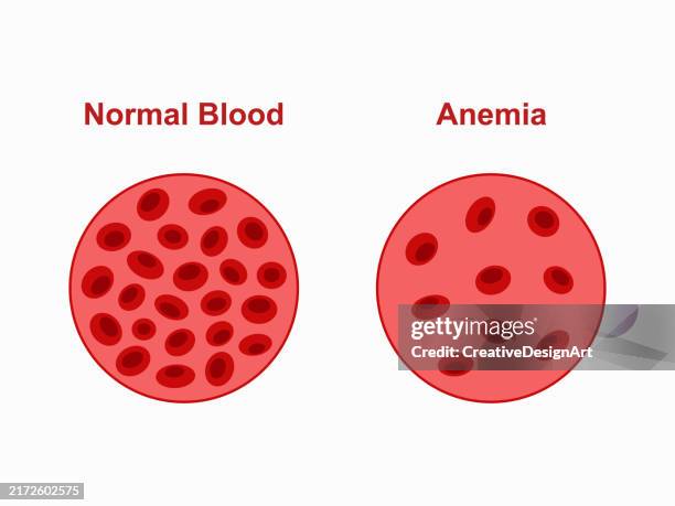 ilustraciones, imágenes clip art, dibujos animados e iconos de stock de comparación de la cantidad normal y anémica de glóbulos rojos - anemia