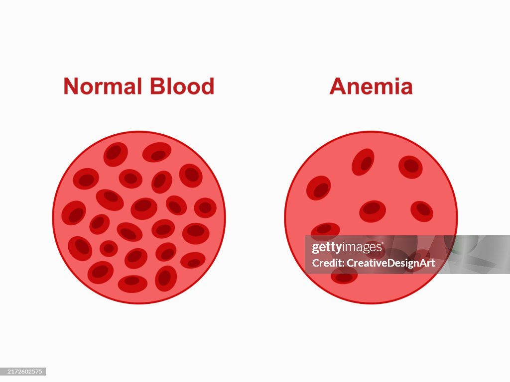 Comparison Of Normal And Anemic Amount Of Red Blood Cells