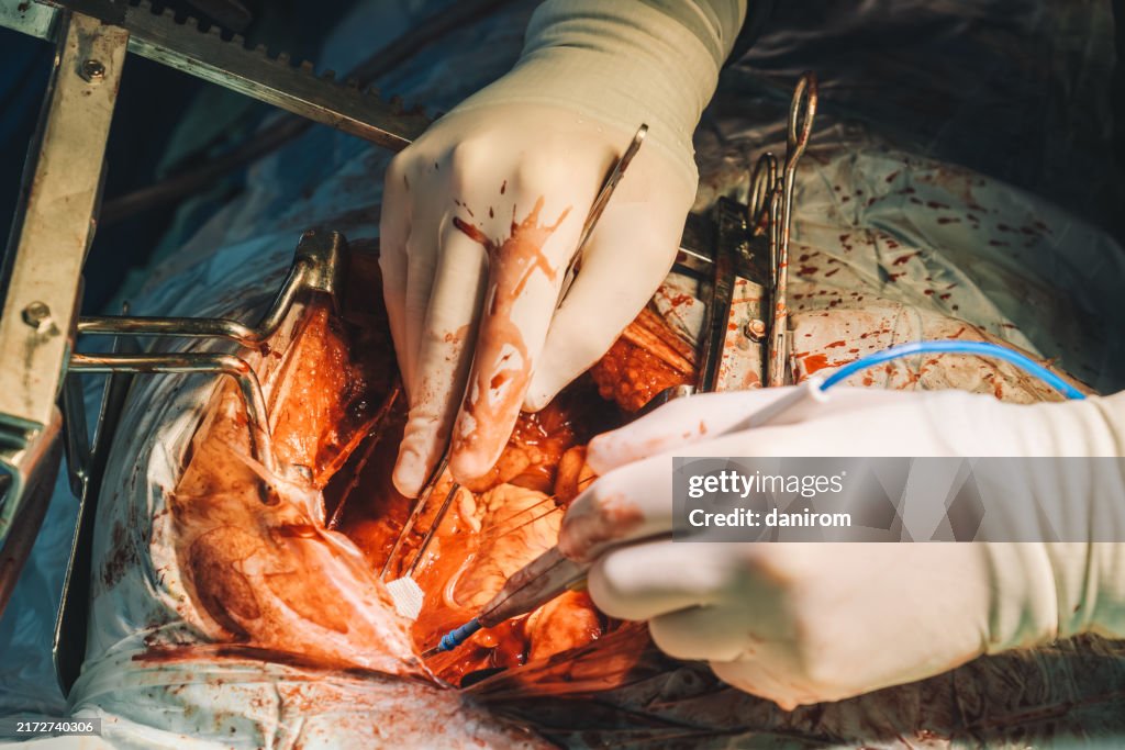 Close-up of open-heart surgery with surgical instruments and precise incision in the chest cavity.