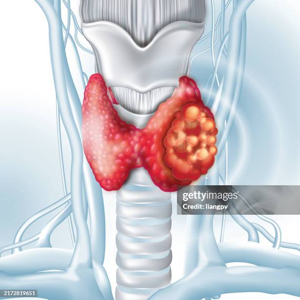 thyroid cancer - hypothyroidism stock illustrations