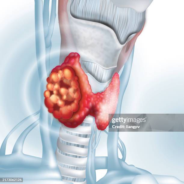 illustrazioni stock, clip art, cartoni animati e icone di tendenza di cancro alla tiroide - tiroide