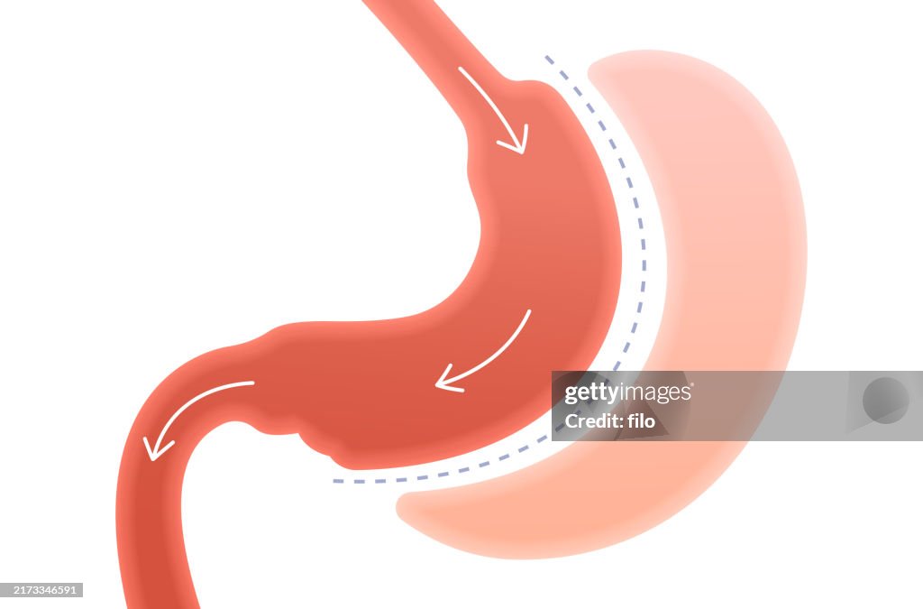 Gastric Bypass Gastrectomy Human Stomach Internal Organ Surgery ...