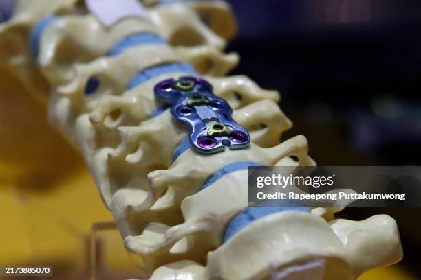 close-up of lumbar spinal fusion implant - bone implant stock pictures, royalty-free photos & images