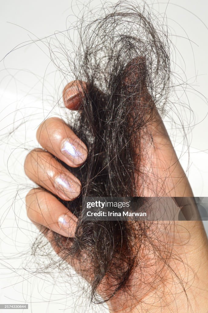 Hairfall, hair loss