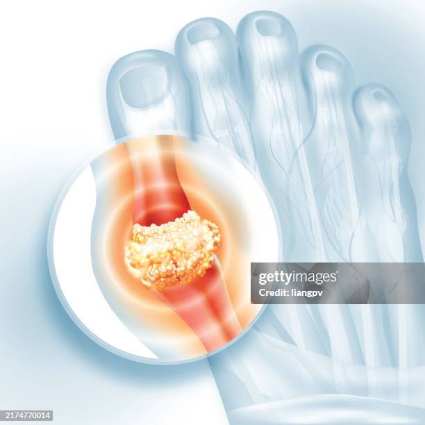 ilustraciones, imágenes clip art, dibujos animados e iconos de stock de gout - gota afección médica